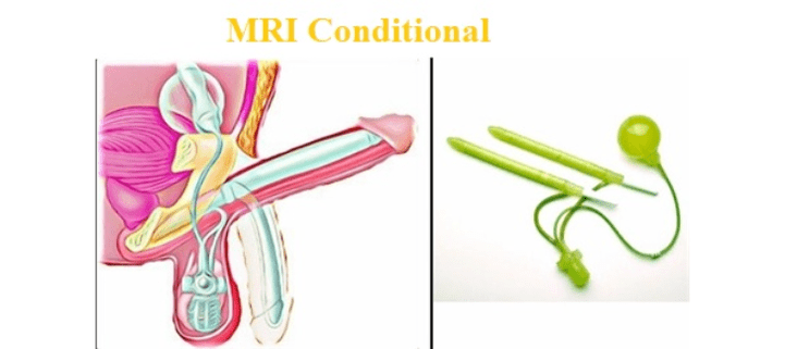 Agrandissement chirurgical du pénis à l'aide d'un implant