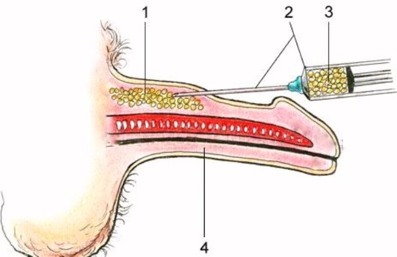 Agrandissement du pénis par injection