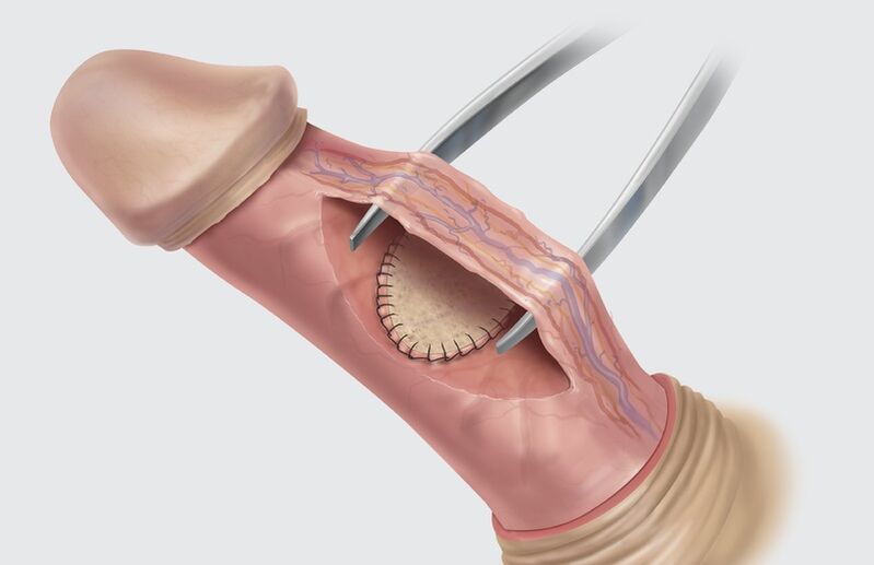 Chirurgie d'agrandissement du pénis