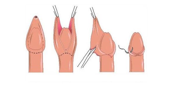 Circoncision du prépuce pour élargissement