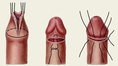 Comment se déroule la chirurgie plastique du pénis